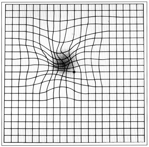 Amsler grid with wavy line distortions.