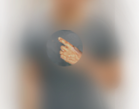 Peripheral vision loss