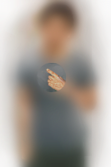 Peripheral vision loss depiction without the support of a low vision aid like eSight glasses.