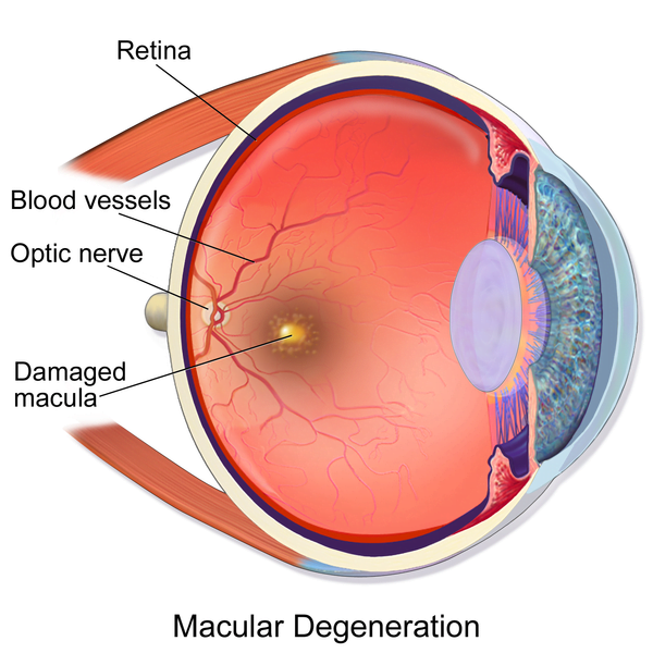 Eye diagram of someone with macular degeneration
